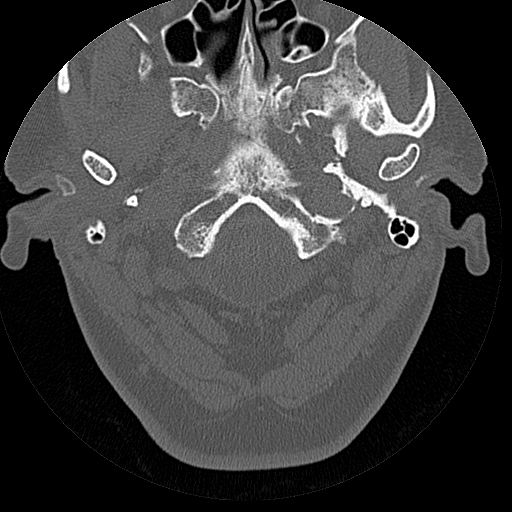 File:Bilateral ossifications of the external auditory canal (Radiopaedia 15233-15076 Axial bone window 24).jpg