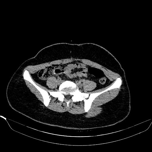 File:Bilateral ovarian dermoid (Radiopaedia 45714-49907 Axial non-contrast 5).JPEG