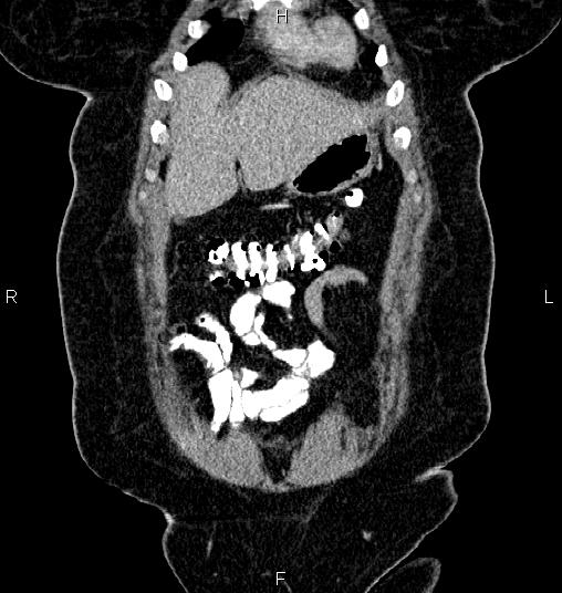 Bilateral ovarian dermoid cysts (Radiopaedia 85785-101603 C 4).jpg