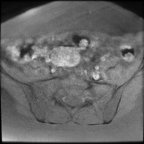File:Bilateral ovarian fibrothecomas - adolescent (Radiopaedia 86604-102707 Axial T1 fat sat 7).jpg