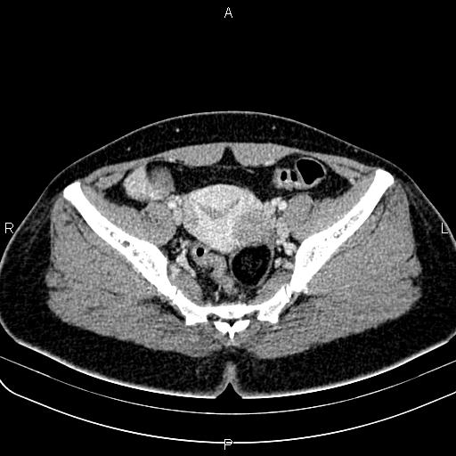 File:Bilateral ovarian teratoma (Radiopaedia 83131-97503 Axial With contrast 38).jpg