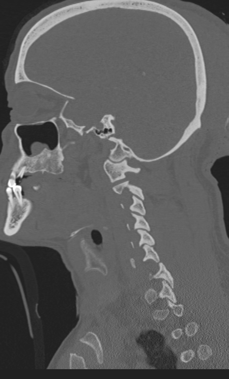 Bilateral perched facet joint (Radiopaedia 63149-71669 Sagittal bone window 55).jpg