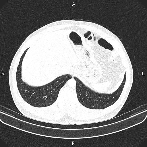 File:Bilateral pulmonary AVM (Radiopaedia 83134-97505 Axial lung window 65).jpg