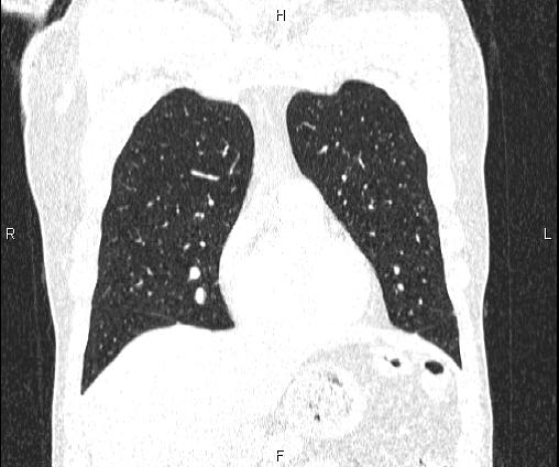Bilateral pulmonary AVM (Radiopaedia 83134-97505 Coronal lung window 29).jpg