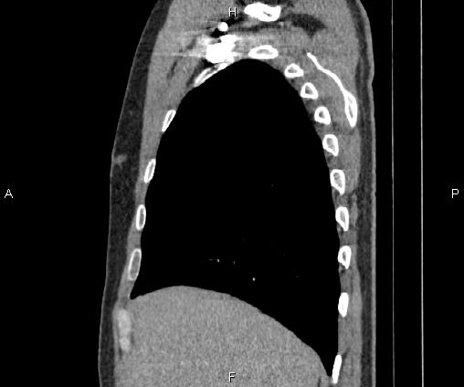 Bilateral pulmonary AVM (Radiopaedia 83134-97505 D 30).jpg