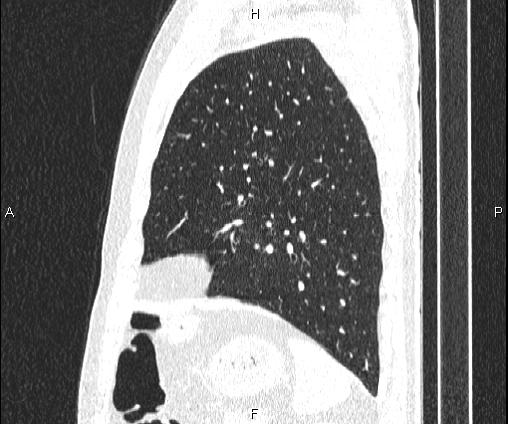 Bilateral pulmonary AVM (Radiopaedia 83134-97505 Sagittal lung window 86).jpg