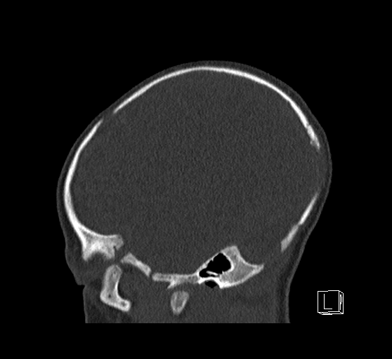 File:Bilateral subdural hemorrhage and parietal skull fracture (Radiopaedia 26058-26192 Sagittal bone window 19).png