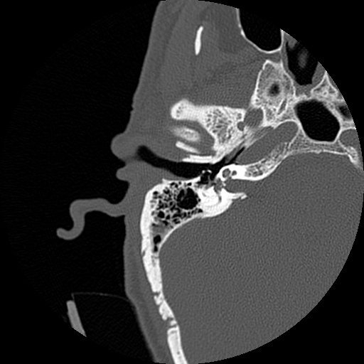 File:Bilateral temporal bone fractures (Radiopaedia 29482-29970 Axial non-contrast 20).jpg