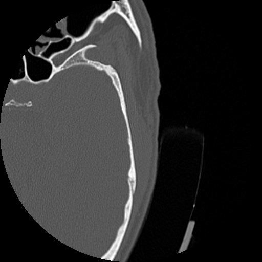 Bilateral temporal bone fractures (Radiopaedia 29482-29970 D 143).jpg