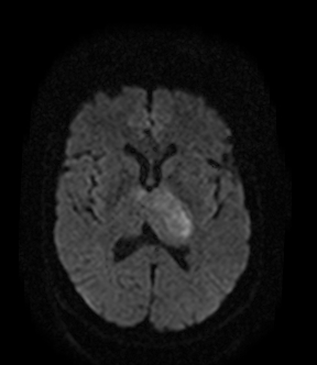 File:Bilateral thalamic glioma (Radiopaedia 65852-75009 Axial DWI 11).jpg