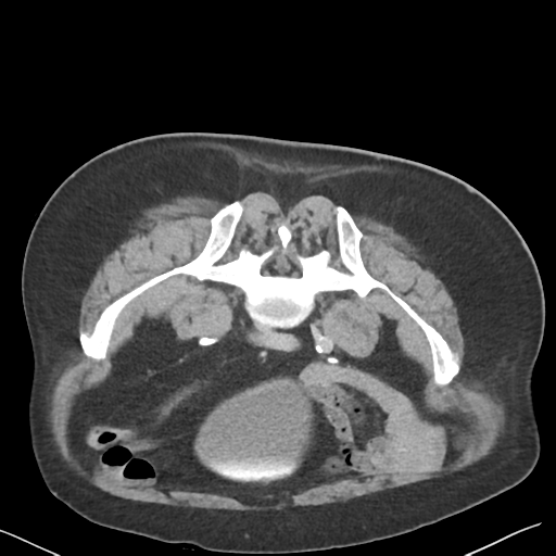 File:Bladder papillary urothelial carcinoma (Radiopaedia 48119-52951 Axial C+ delayed 39).png