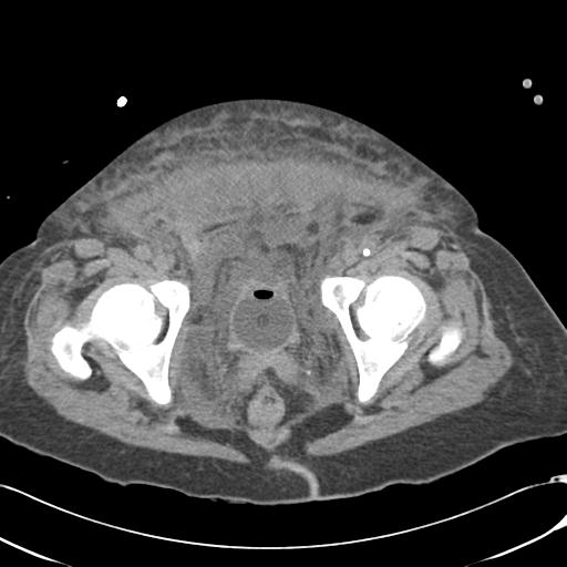 Bladder rupture post renal biopsy (Radiopaedia 30863-31572 Axial non-contrast 82).jpg