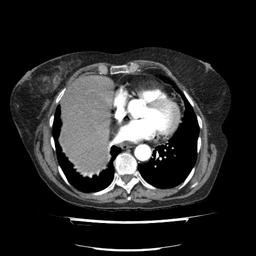 Bladder tumor detected on trauma CT (Radiopaedia 51809-57609 A 60).jpg