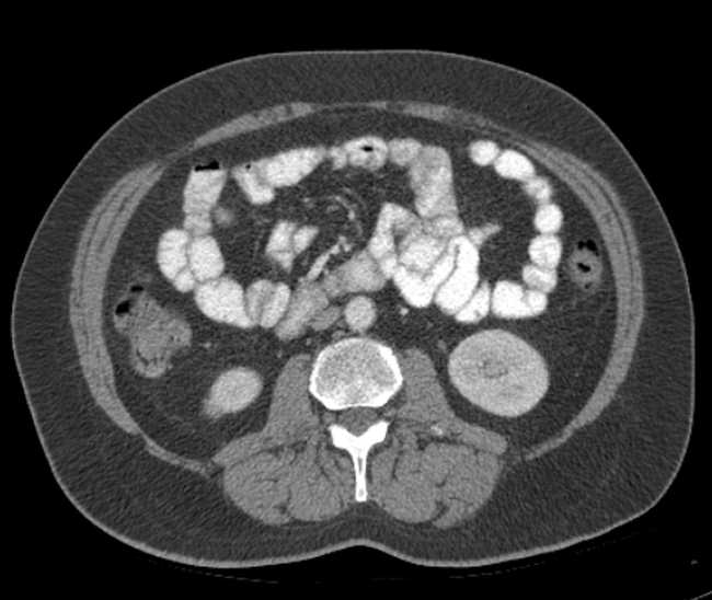 Bleeding duodenal ulcer and adenomyomatosis of gallbladder (Radiopaedia 61834-69861 A 62).jpg