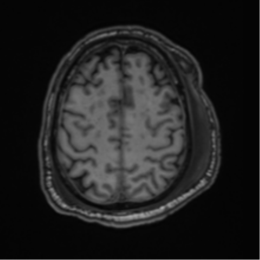 File:Blunt cerebrovascular injury (Radiopaedia 53682-59745 Axial T1 25).png