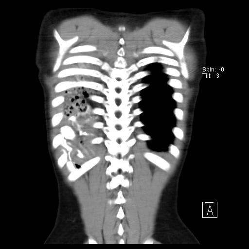 File:Bochdalek diaphragmatic hernia (Radiopaedia 38866-41059 Coronal liver window 19).jpg