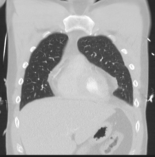Boerhaave syndrome (Radiopaedia 39382-41661 Coronal lung window 13).png