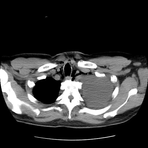File:Boerhaave syndrome (Radiopaedia 59796-67310 Axial liver window 12).jpg
