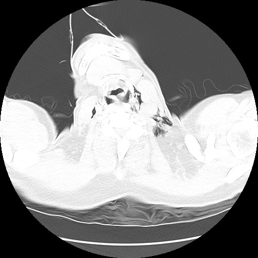 Boerhaave syndrome (Radiopaedia 59796-67310 Axial lung window 2).jpg