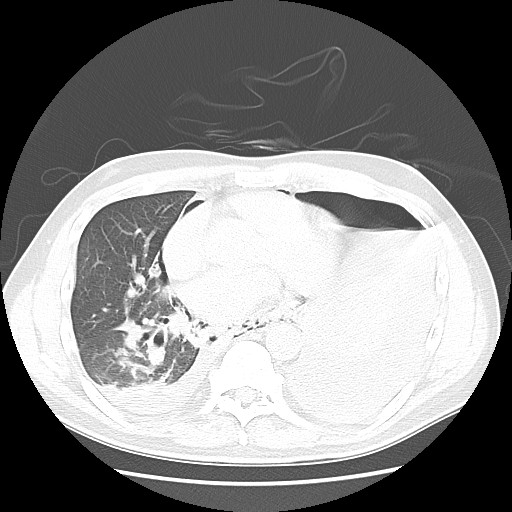 Boerhaave syndrome (Radiopaedia 59796-67310 Axial lung window 38).jpg
