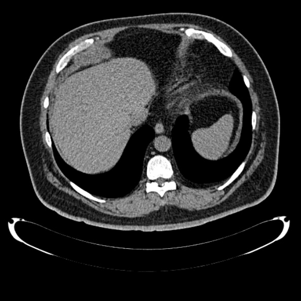 File:Bosniak renal cyst - type IV (Radiopaedia 24244-24518 Axial non-contrast 47).jpg