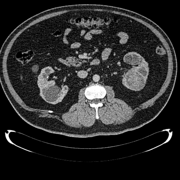 Bosniak renal cyst - type IV (Radiopaedia 24244-24518 C 164).jpg