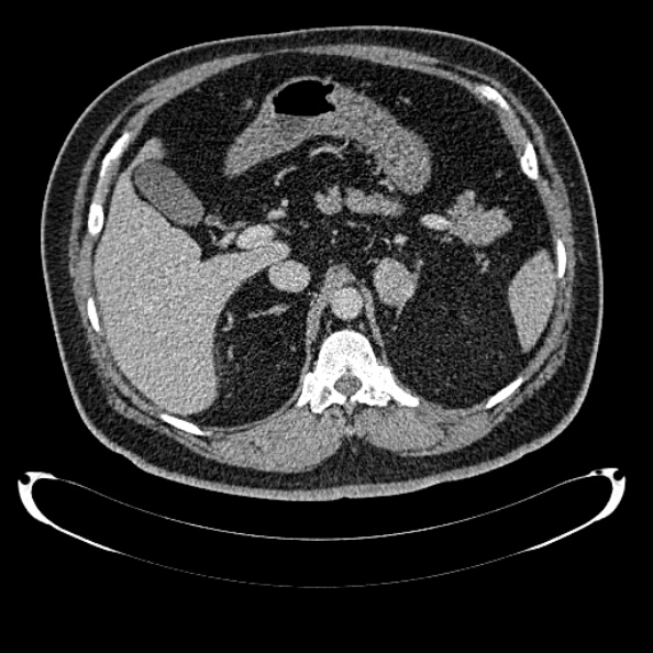 File:Bosniak renal cyst - type IV (Radiopaedia 24244-24518 C 87).jpg