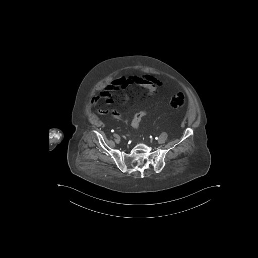 File:Bowel ischemia secondary to SMA occlusion with extensive portomesenteric venous gas (Radiopaedia 54656-60871 A 11).jpg