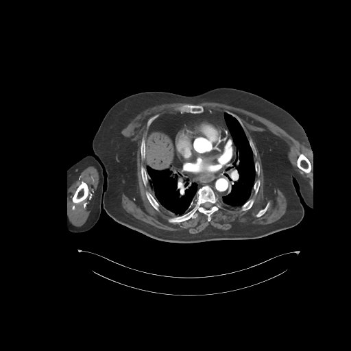 File:Bowel ischemia secondary to SMA occlusion with extensive portomesenteric venous gas (Radiopaedia 54656-60871 A 80).jpg