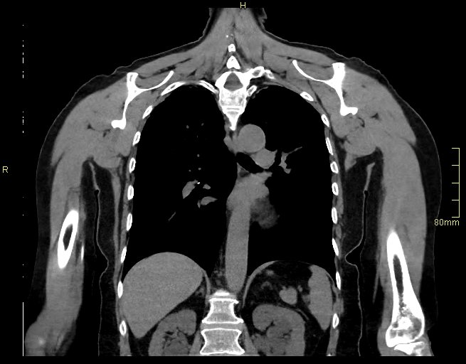 Brachial artery foreign body (Radiopaedia 54583-60820 Coronal non-contrast 36).jpg