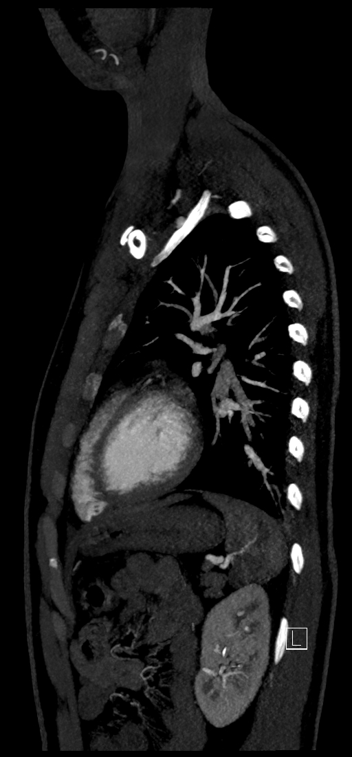 Brachiocephalic trunk pseudoaneurysm (Radiopaedia 70978-81191 C 68).jpg