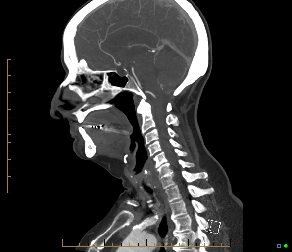 Brachiocephalic trunk stenosis (Radiopaedia 87242-103519 C 33).jpg
