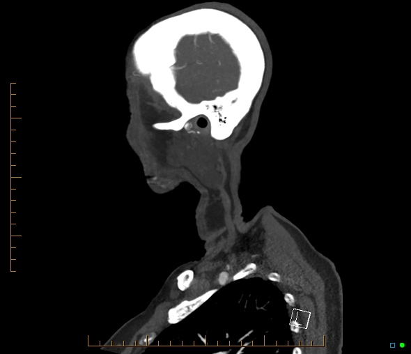 Brachiocephalic trunk stenosis (Radiopaedia 87242-103519 C 6).jpg