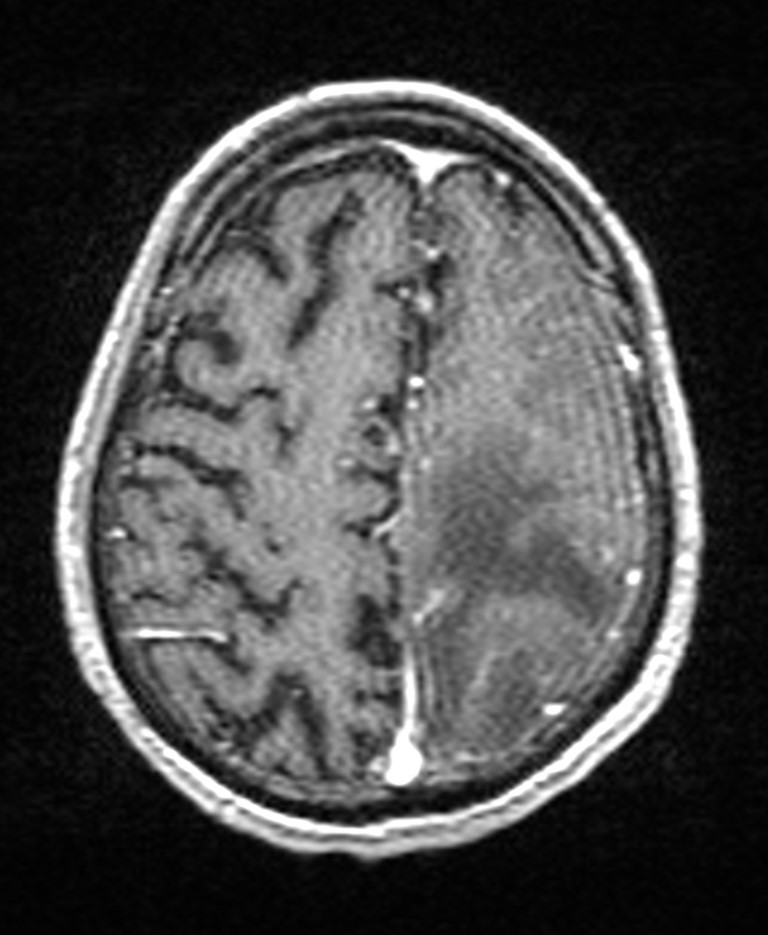 Brain abscess with dual rim sign (Radiopaedia 87566-103938 Axial T1 C+ 125).jpg