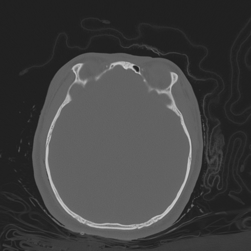 Brain contusions, internal carotid artery dissection and base of skull fracture (Radiopaedia 34089-35339 Axial bone window 75).png
