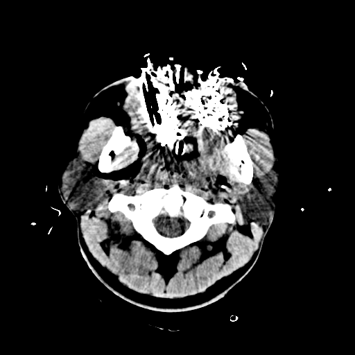 File:Brain contusions, internal carotid artery dissection and base of skull fracture (Radiopaedia 34089-35339 Axial non-contrast 12).png