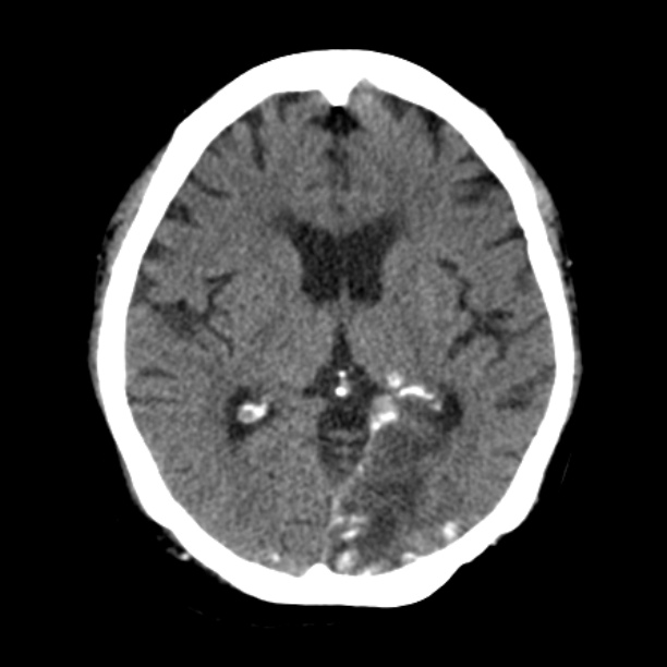 Brain cortical laminar necrosis (Radiopaedia 25822-25971 Axial non-contrast 23).jpg