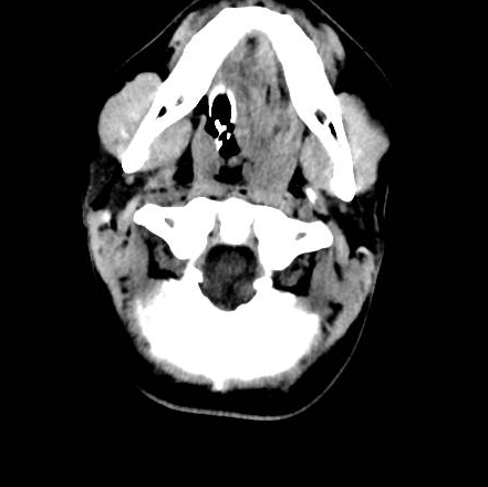 File:Brain death after motor vehicle collision (Radiopaedia 88470-105114 Axial 29).png