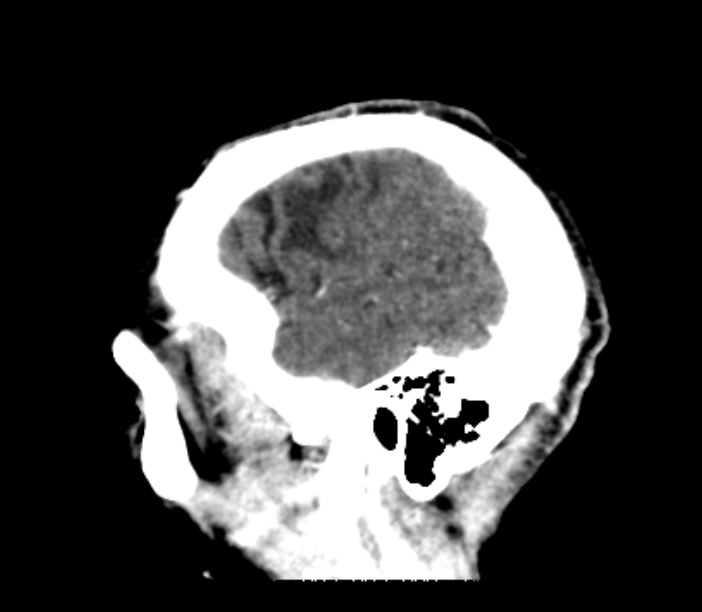 Brain metastases from lung cancer (Radiopaedia 27849-28092 Sagittal C+ delayed 10).jpg
