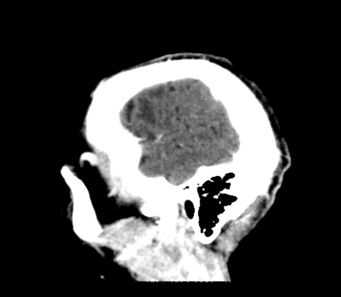 Brain metastases from lung cancer (Radiopaedia 27849-28092 Sagittal C+ delayed 9).jpg