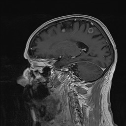 Brain metastasis (Radiopaedia 42617-45761 Sagittal T1 C+ 63).jpg