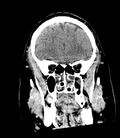 File:Brainstem hemorrhage (Radiopaedia 81294-94976 Coronal non-contrast 18).jpg