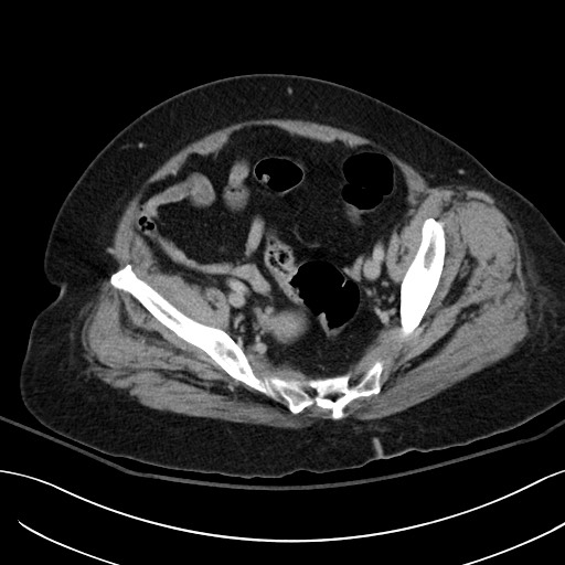 Breast carcinoma with pathological hip fracture (Radiopaedia 60314-67974 B 59).jpg