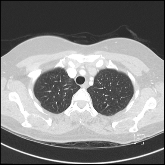Breast metastases from renal cell cancer (Radiopaedia 79220-92225 Axial lung window 15).jpg