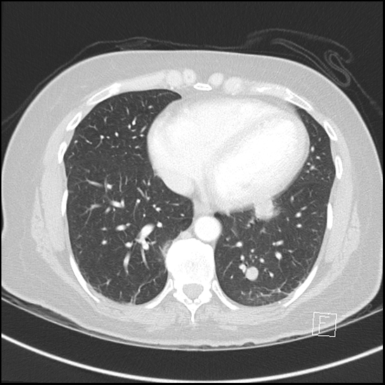 Breast metastases from renal cell cancer (Radiopaedia 79220-92225 Axial lung window 60).jpg