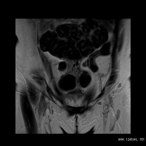 File:Broad ligament fibroid (Radiopaedia 49135-54241 Coronal T2 5).jpg