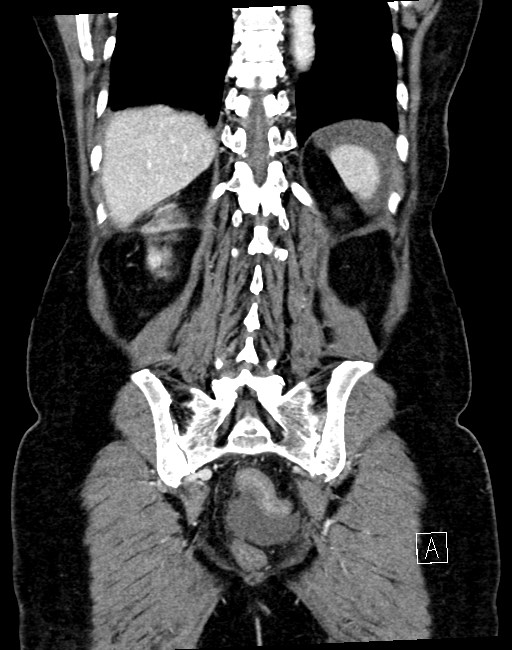 Broad ligament hernia (Radiopaedia 84802-100276 B 10).jpg