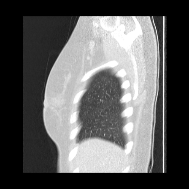Bronchial atresia (Radiopaedia 22965-22992 Sagittal lung window 49).jpg