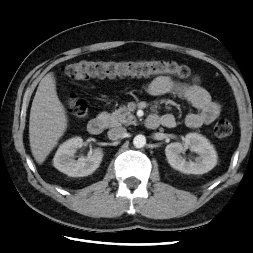 Bronchial carcinoid tumor (Radiopaedia 67377-76764 A 72).jpg