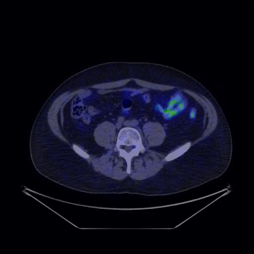 File:Bronchial carcinoid tumor (Radiopaedia 67377-76765 68Ga-DOTATATE PET-CT 60).jpg